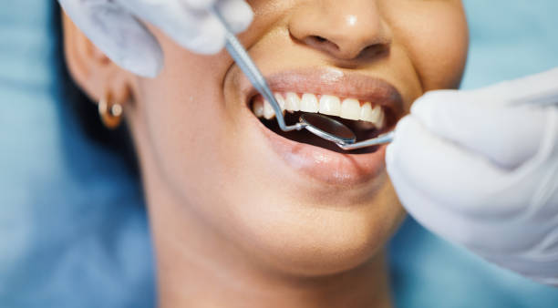 Best Emergency Wisdom Teeth Removal in Galliano, LA